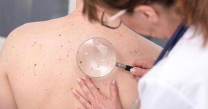 Melanoma: cuida tu piel, revisá tus lunares