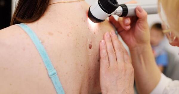 Melanoma: Salud recuerda que es importante revisar la piel y cuidar los lunares