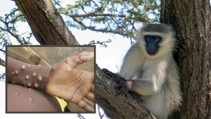 Paraguay activa alerta epidemiológica ante aparición de viruela del mono - El Independiente