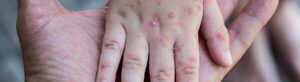 Alerta epidemiológica ante aparición de viruela símica en países no endémicos - La Clave