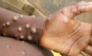 Diario HOY | Epidemiólogo insiste en que aún "es pronto" para hablar de epidemia de viruela del mono