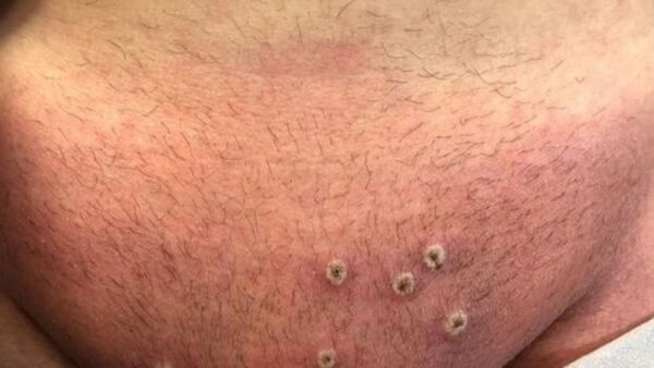 España detecta 59 casos de viruela del mono y comprará vacunas a través de la UE