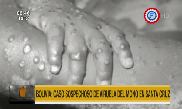 Detectan caso sospechoso de viruela del mono en Bolivia | Telefuturo