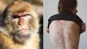 Argentina confirmó el segundo caso de viruela del mono en el país
