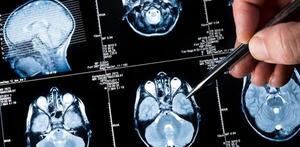 Diario HOY | Nueva técnica permite extirpar tumor cerebral preservando un área del lenguaje