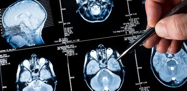 Diario HOY | Nueva técnica permite extirpar tumor cerebral preservando un área del lenguaje