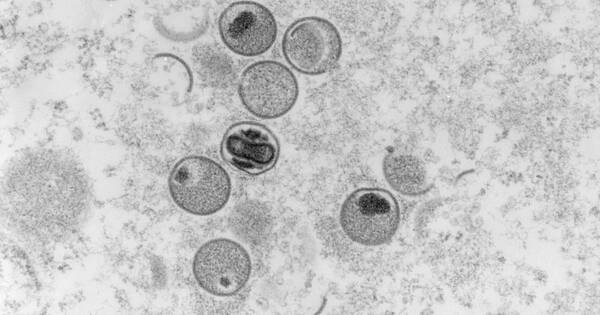 La Nación / Viruela del mono: Francia confirma 33 casos