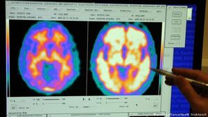 Nuevo estudio cuestiona duramente la principal teoría sobre las causas y tratamientos del Alzheimer