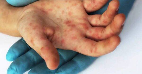 La Nación / Viruela del mono: en Francia confirman 33 casos de la enfermedad