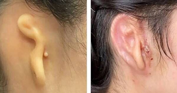 La Nación / Científicos reconstruyen una oreja gracias a tejido de células humanas impresas en 3D
