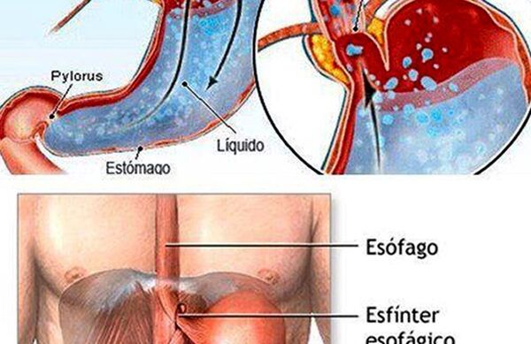 Reflujo gastroesofágico - Nacionales - ABC Color