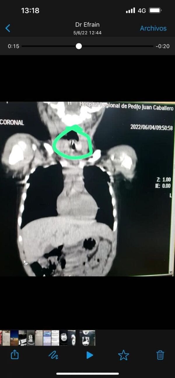 Nene de 3 años tenía un pedazo de hueso atascado en la laringe