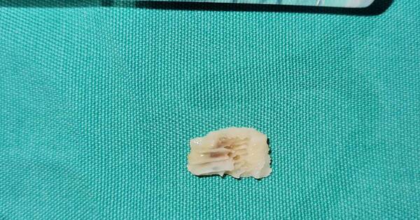La Nación / Niño de 3 años, con dificultad respiratoria por hueso de puchero atascado en la garganta