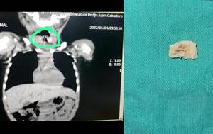 Niño de 3 años fue intervenido tras atascársele un hueso luego de comer puchero – Prensa 5