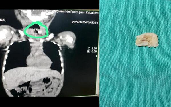 Niño de 3 años fue intervenido tras atascársele un hueso luego de comer puchero – Prensa 5