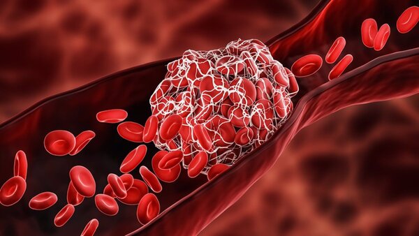 Piden ayuda económica para comprar medicamento a paciente con enfermedad rara de la sangre