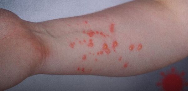 OMS registra 1.000 casos de viruela del mono y teme que virus se instale en países no endémicos