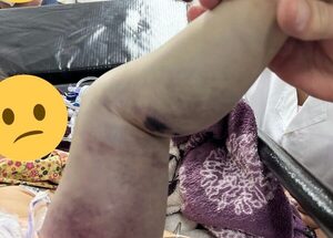 Beba de 2 años grave tras ser mordida por un yarará en San juan Nepomuceno