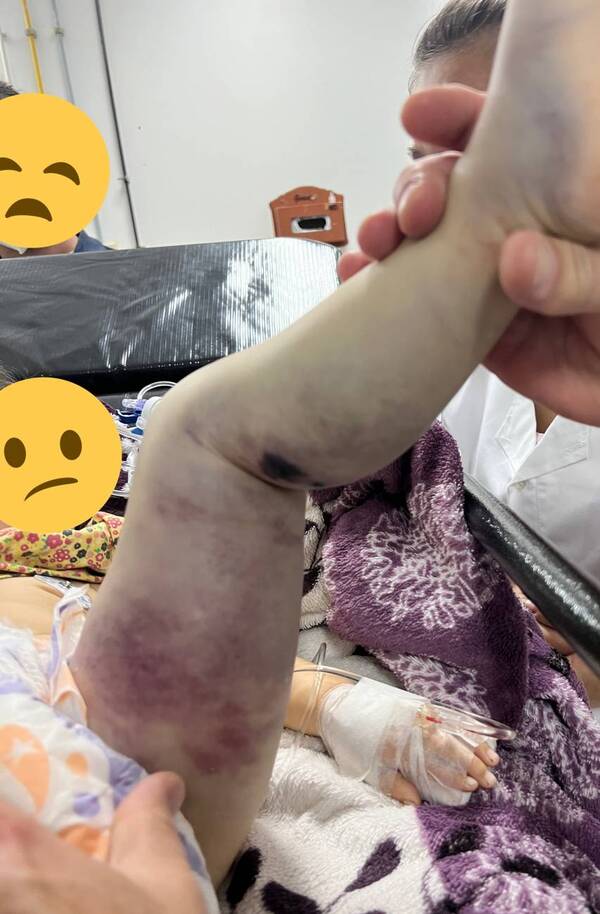 Crónica / Beba que fue mordida por un yarará está evolucionando bien