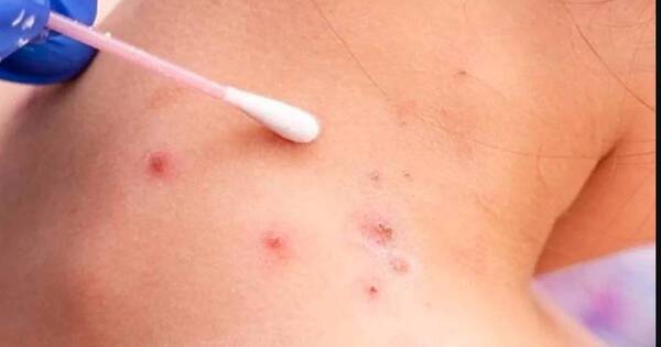 La Nación / Brasil confirma primer caso de viruela del mono