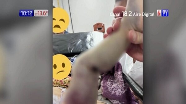 ¡Tremendo! Beba fue mordida por una yarará | Noticias Paraguay