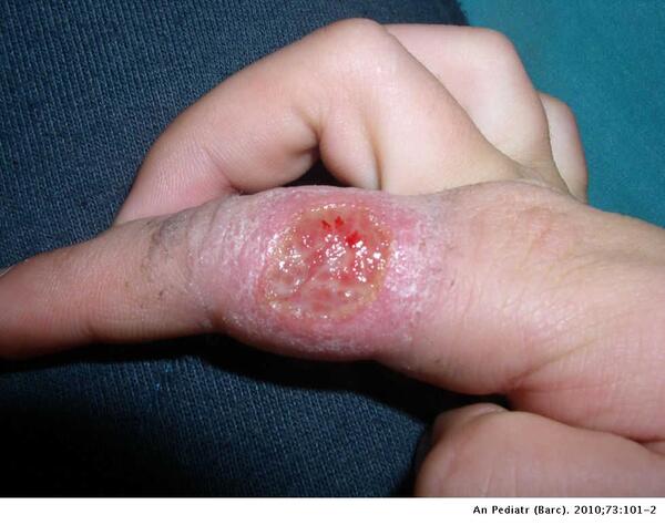 LEISHMANIASIS: CONOZCAMOS Y PREVENGAMOS ESTA ENFERMEDAD