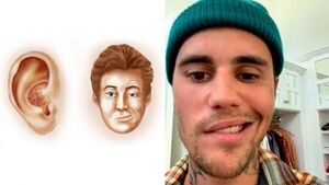 Qué es el síndrome de Ramsay Hunt, el padecimiento de Justin Bieber