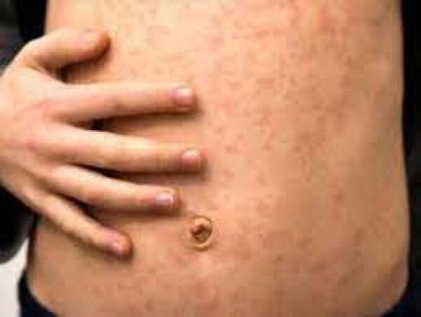 Brasil confirma tercer caso de viruela del mono