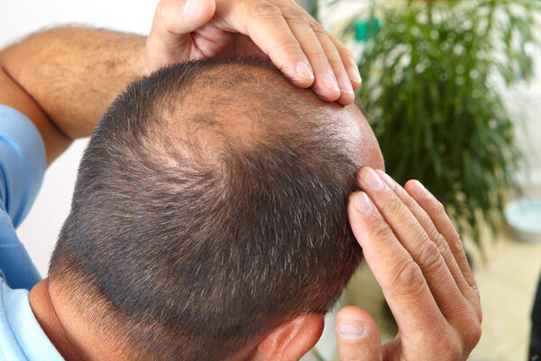 MUNDO | EEUU aprueba primera píldora para el tratamiento de la alopecia