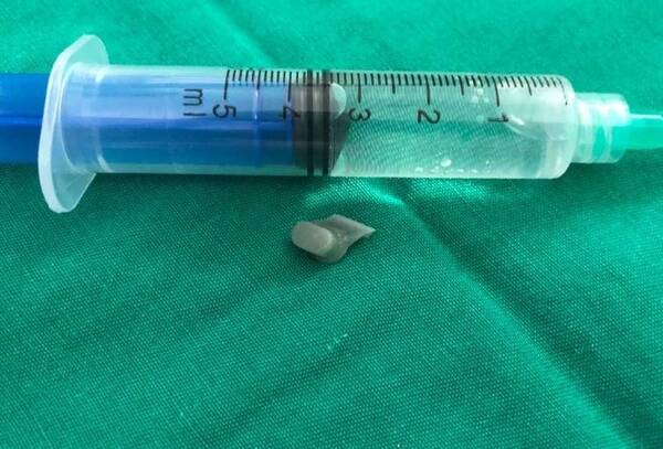 Bebé de dos añitos se tragó botón del control de la tele
