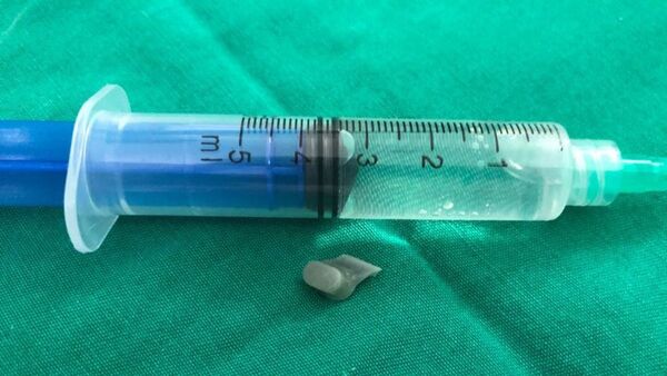 Nene aspiró la tecla de un control y terminó en su pulmón