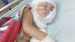Bebé se quemó con aceite caliente y está grave