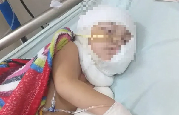 Bebé está grave tras quemarse con aceite caliente - Noticiero Paraguay