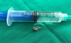 Niño de dos años aspiró la tecla de un control remoto y fue intervenido - OviedoPress