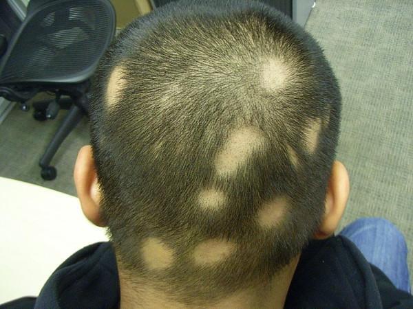 Diario HOY | Alopecia areata puede llevar a la calvicie total