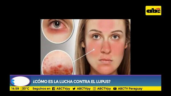 Identifican un nuevo marcador para el lupus - Estilo de vida - ABC Color