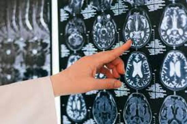 Diario HOY | Nuevo estudio sobre covid en EEUU ayuda a comprender la "niebla cerebral"