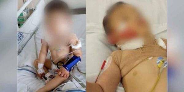 Crónica / Papá descuidado derramó caldo caliente de kuré akãngue por su hijo