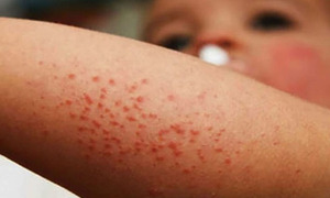 Casos de sarampión en la región alertan de amenaza de reingreso e instan a la vacunación