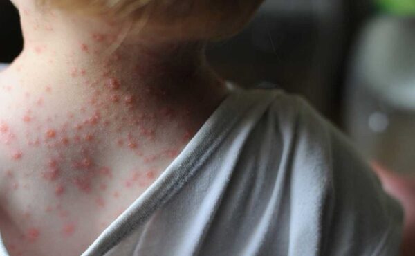 OMS ACTIVA SU MÁXIMO NIVEL DE ALERTA SANITARIA PARA CONTENER EL BROTE DE VIRUELA DEL MONO