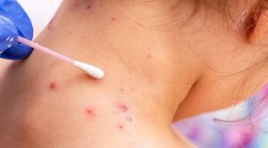 Viruela del mono: vigilancia y situación epidemiológica regional en debate
