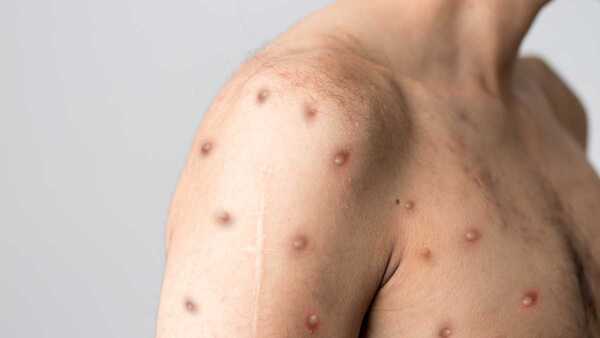 Infectóloga pide tomar recaudos ante aumento de casos de la viruela del mono