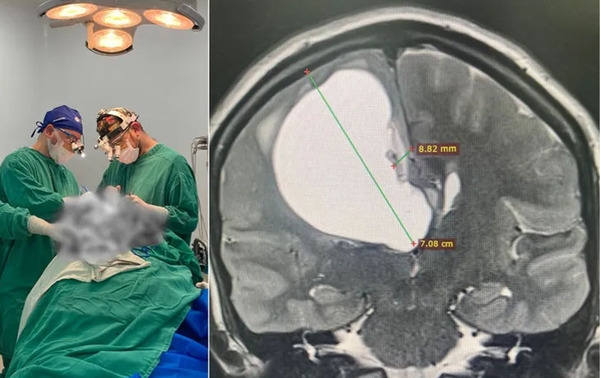 Fue al hospital por un dolor de cabeza y la operaron de un tumor en Encarnación – Prensa 5