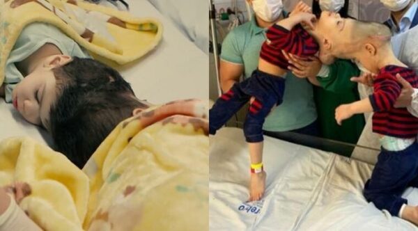 Gemelos siameses unidos por la cabeza, separados con éxito tras siete cirugías