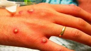 Crónica / Alerta ante eventual brote de casos de viruela de mono en el país