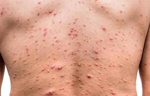 Estados Unidos declara emergencia de salud nacional por brote de viruela del mono