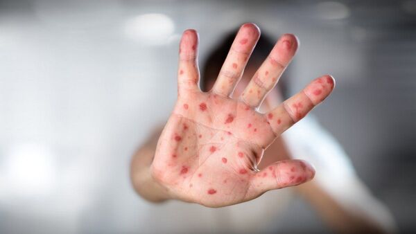 EEUU declarará emergencia sanitaria por la viruela del mono