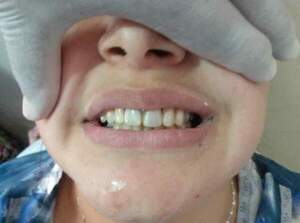 Pacientes de Mallorquín recuperan sonrisa con prótesis dentales