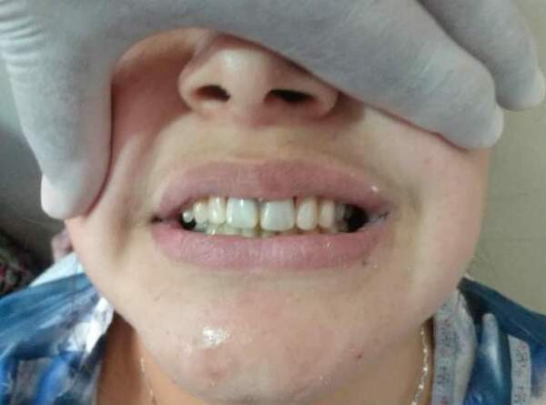 Pacientes de Mallorquín recuperan sonrisa con prótesis dentales