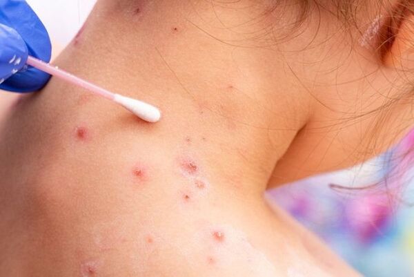 No hay viruela del mono en el país pero piden consultar ante síntomas